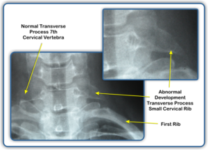 What is Thoracic Outlet Syndrome? – Coon Rapids Chiropractic