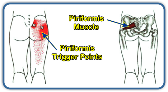 Piriformis Syndrome And Lower Back Pain Coon Rapids Chiropractic